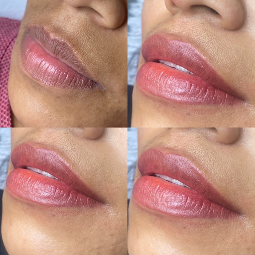 Lip Treatment Result 1